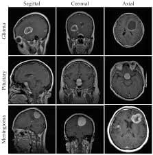 AI Brain Tumor Detection
